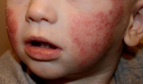 Dermatitis Pediátrica